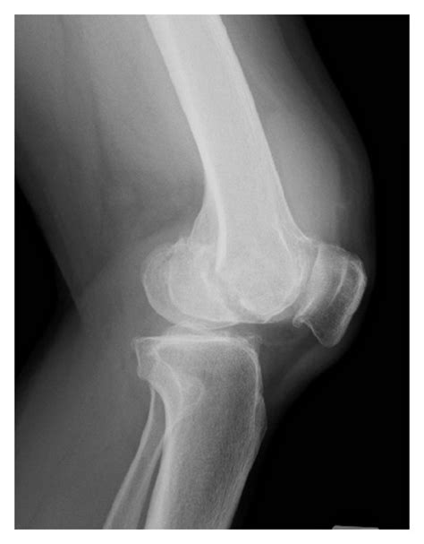 Initial Posttraumatic Anteroposterior A And Lateral B Radiographs