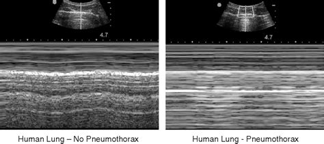 Table From M Mode Ultrasound For The Detection Of Pneumothorax During