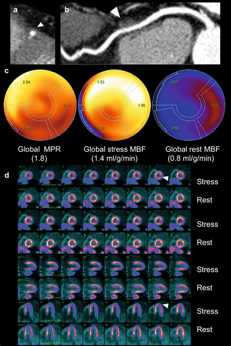 Myocardial Bridging Of The Left Anterior Descending Coronary Artery Is