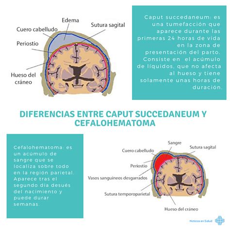 Cefalohematoma Archivos Noticias En Salud