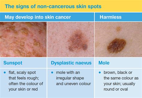 Examples Of Skin Cancer Spots