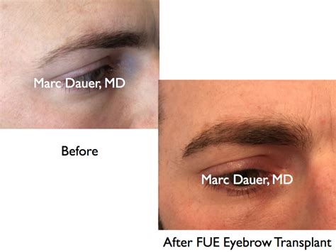 Eyebrow Transplant Photos Los Angeles Eyebrow Transplantation