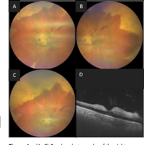 Figure From Acute Retinal Necrosis With Central Retinal Artery