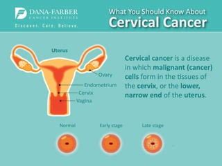 What You Should Know About Cervical Cancer Ppt