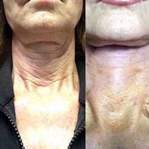 Botox For Neck Bands Before And After Facial Injections Info Prices