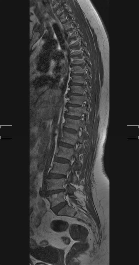 MRI TEST 1 SPINE Classification Dataset by Spine MRI