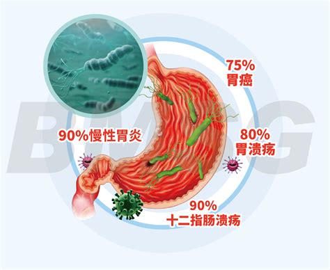 警惕身体的异常变化你可能被幽门螺杆菌感染 知乎