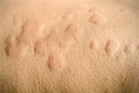 Hives For No Reason It Might Be Chronic Idiopathic Urticaria The Healthy