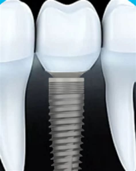 Dental Implant System At Best Price In Bengaluru By Intessence