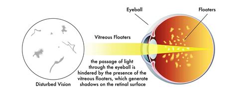 Eye Floaters - Symptoms and Causes - Eye Contact Optician