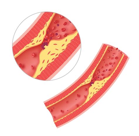 Premium Photo | Atherosclerosis in artery