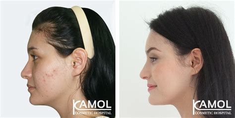 Forehead Implant Kamol Cosmetic Hospital