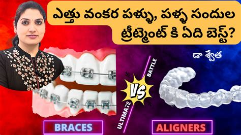 Braces vs Aligners Which is the Best Option for Teeth Straightening