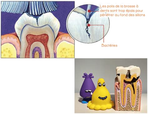 Le Scellement De Sillons Dentiste