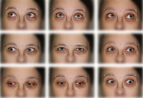 Figure 2 From Surgical Treatment Of A Patient With Congenital Nystagmus