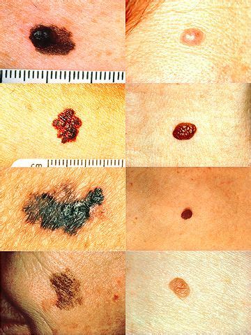 Melanoma Della Pelle Immagini Foto Sintomi E Metastasi