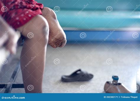 knee amputee patient stock image image  medical
