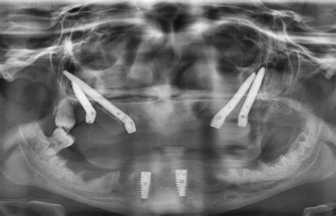 Simultaneous Le Fort I Osteotomy And Zygomatic Implant Placement Zygo Pro