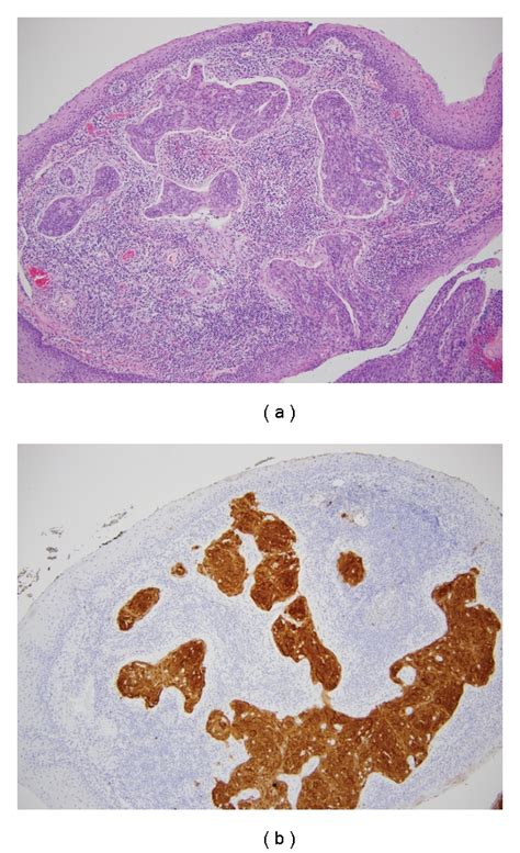 A Hematoxylin And Eosin Stained Section Of The Left Tonsil Showing