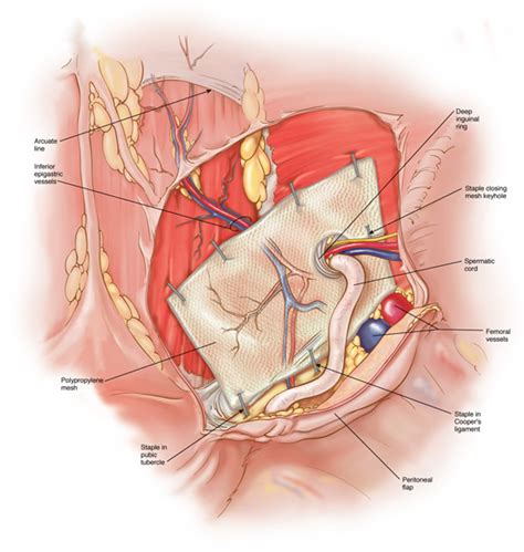 Open Inguinal Hernia Repair Anatomy