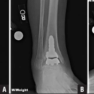 Preoperative Weight Bearing Anteroposterior A Mortise B And