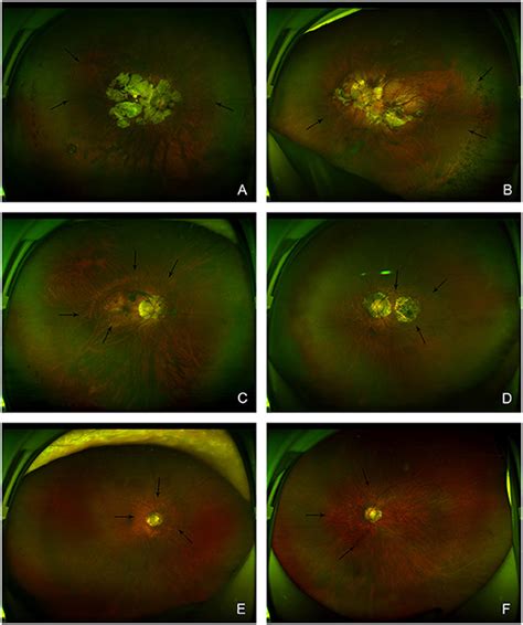 Peripapillary Staphyloma