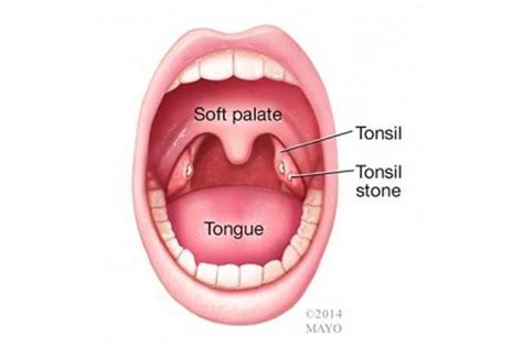 Tonsil Stones: Causes, Removal & Prevention | Live Science