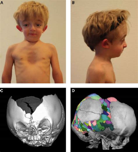 Carpenter syndrome causes, symptoms, diagnosis, treatment & life expectancy