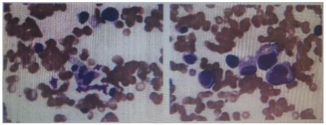 Bone Marrow Aspirate Smears Showing Hemophagocytosis Download