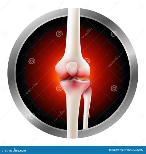 Icon Showing Symptoms of Knee Arthritis. Stock Illustration