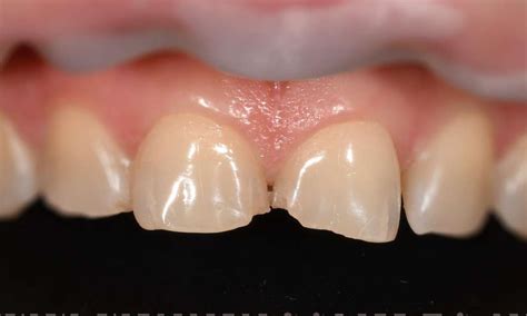 Veneers To Restore Chipped Front Teeth Before And After Photos