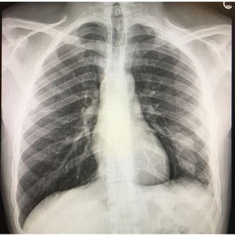 Ct Chest On Admission Note The Diffuse And Peripheral Ground Glass Download Scientific Diagram