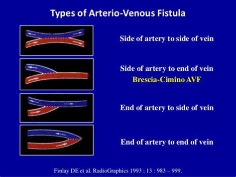 Upper Extremity Venous Mapping & Dialysis Grafts Flashcards | Quizlet