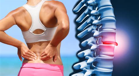 Understanding Herniated Discs 11 Factors Behind Symptoms And