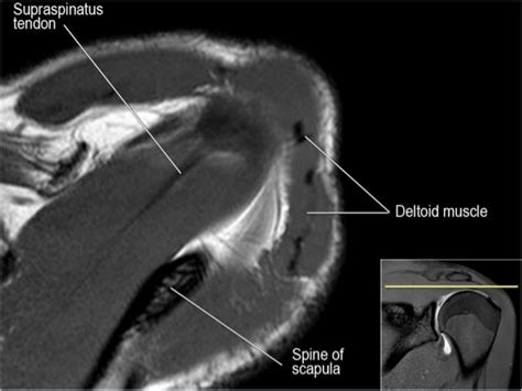 Mri Musculo Skeletal Section Mri Anatomy Of The Shoulder Axial View