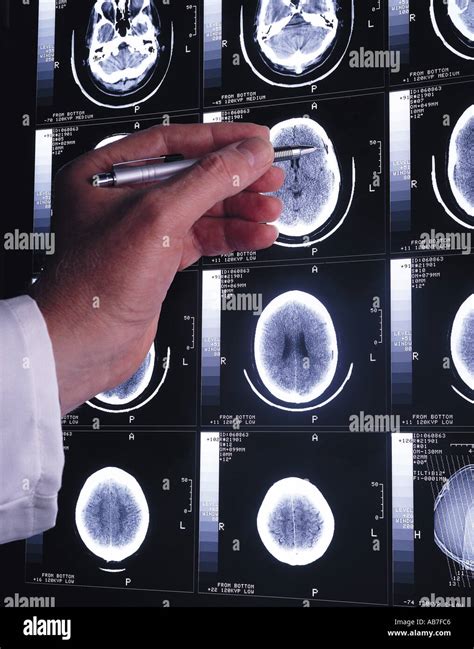 Brain scans hi-res stock photography and images - Alamy