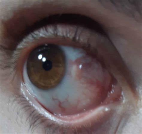 Forum Yellow zone and redness in the sclera Área Oftalmologica