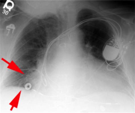 Clin Skills Chest Radiography Flashcards Quizlet