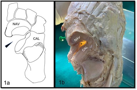 Revisiting The Inferior Supports Of Chopart Joint Complex Bone And Joint