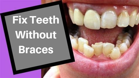 How To Fix Crooked Bottom Teeth Without Braces Mouth Ninja