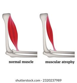 Muscle Strain Grading Grade 1 Minimal Stock Vector (Royalty Free ...