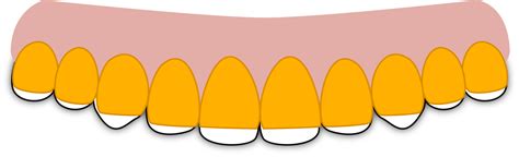 Classification Of Bruxism Teeth Grinding Serverity Scale And Diagnosis Guide