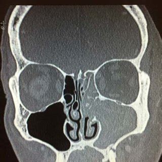 A. Pre-operative CT sinus showing left ostiomeatal complex sinus... | Download Scientific Diagram