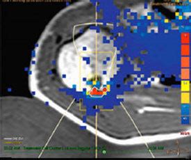 High-Intensity Focused Ultrasound – Turku HIFU Research Centre