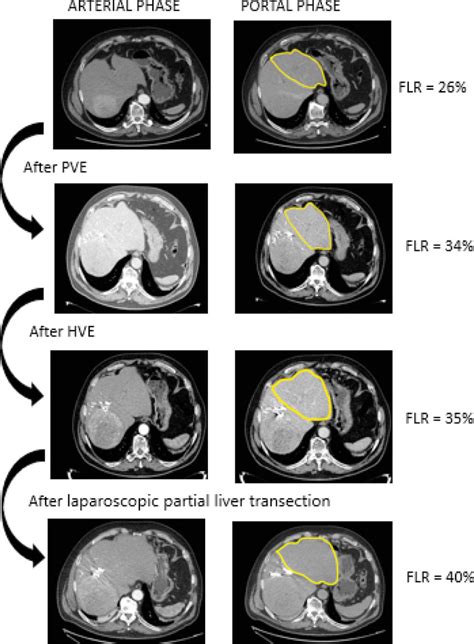 Series Of Contrast Enhanced Computed Tomography In The Arterial And