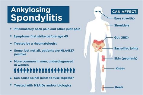 Productos biológicos para la espondilitis anquilosante Clínica de ciática