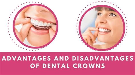 What Are The Advantages And Disadvantages Of Dental Crowns Sayzn