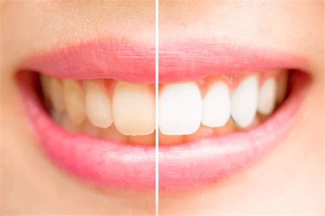 Causes Of Yellow Teeth Rexburg Eagle Rock Dental