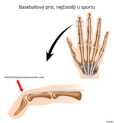 Jak Poznat Narazeny Prst Na Ruce