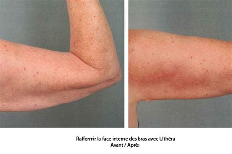 Retendre La Peau Des Bras Sans Chirurgie Avec L Ultherapy Ultherapy Paris